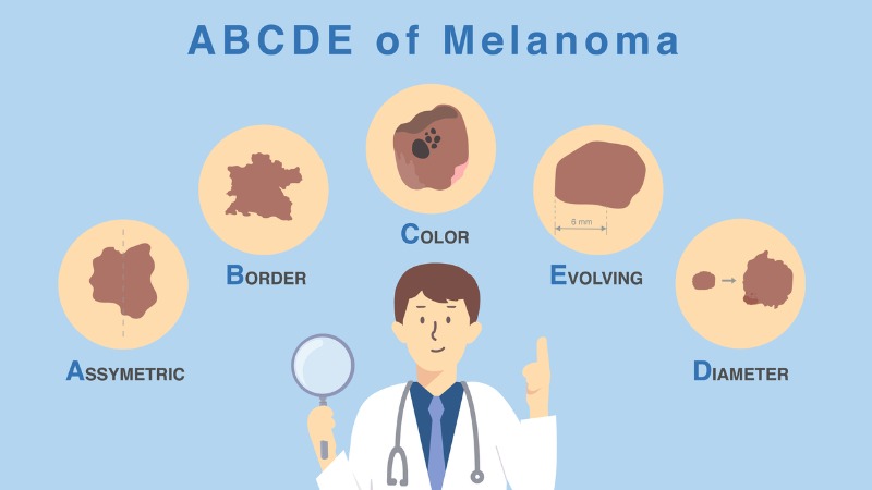how to detect skin cancer abcde rule
